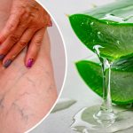 Втомилися від варикозу, тяжкості в ногах та набряків? Спробуйте цей простий засіб з алое вера в домашніх умовах!
