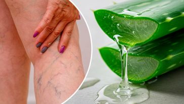 Втомилися від варикозу, тяжкості в ногах та набряків? Спробуйте цей простий засіб з алое вера в домашніх умовах!