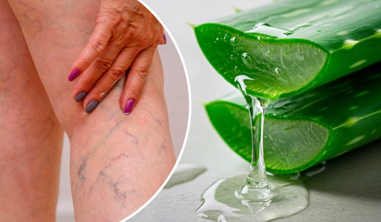 Втомилися від варикозу, тяжкості в ногах та набряків? Спробуйте цей простий засіб з алое вера в домашніх умовах!