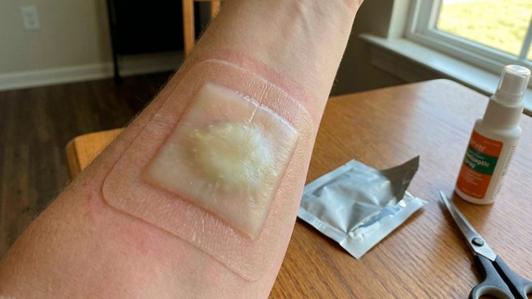 Найкращі гідроколоїдні пов’язки для опіків і хронічних ран